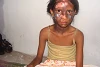 Das christliche Mädchen erlitt bei den Angriffen von Hindu-Extremisten im Sommer 2008 Verbrennungen (csi)