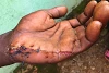 Fulani-Milizen verletzten Jerrys Hand schwer (csi)