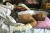Tejal (Name geändert) wurde von acht Bombensplittern verletzt und erlitt Verbrennungen am Gesicht und an den Armen. Es dauert noch lange, bis er wiederhergestellt ist; CSI beteiligt sich an den Behandlungskosten (zvg)
